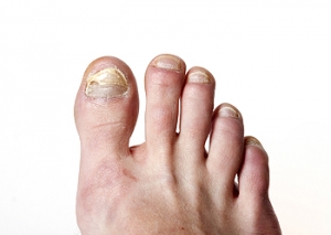 Medical Conditions May Precede Developing Toenail Fungus