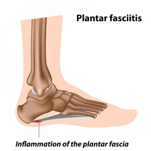 A Stabbing Heel Pain