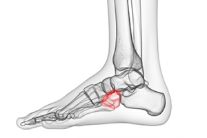 Information About Cuboid Syndrome