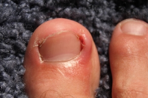 What Causes An Ingrown Toenail?