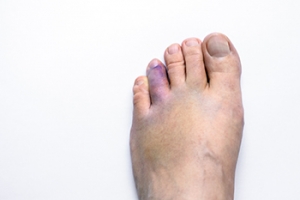 How Are Broken Toes Treated?