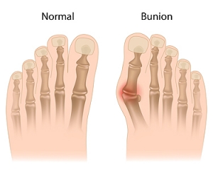 Understanding and Preventing Bunions