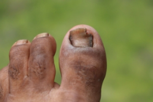 How Diabetes Can Impact Toenails