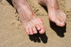 Possible Causes of Hammertoe