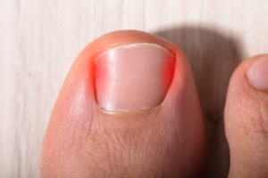 How Do Ingrown Toenails Develop?