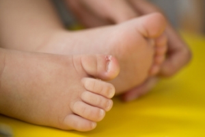 Ingrown Toenails in Children