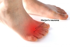 What Are Signs of Morton’s Neuroma?