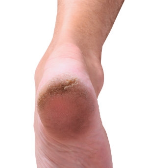 What Causes Cracked Heels?