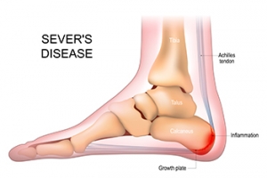 Symptoms of Sever’s Disease in Children