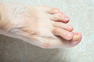 Causes of Hammertoe