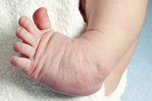 Dealing With Your Child&#039;s Clubfoot