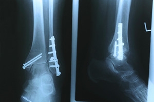 What Causes a Stress Fracture to Develop?