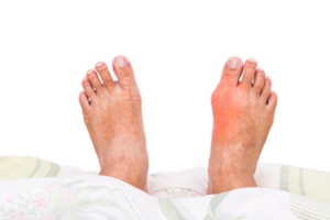 What Causes Gout?